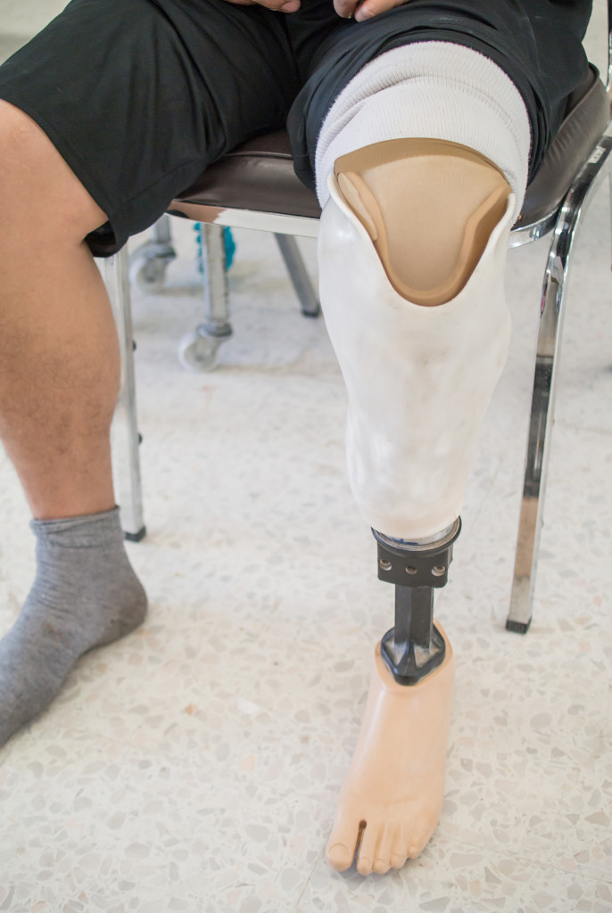 A person with an artificial leg